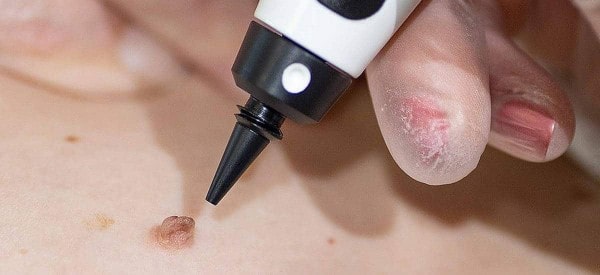 After Skin Tag Removal Chigwell