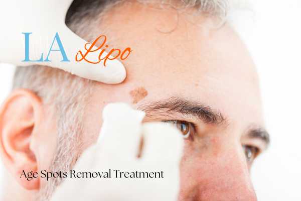 What Are the Most Effective Treatments for Age Spots Chigwell?