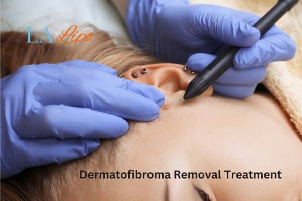 Dermatofibroma Removal Treatment Chigwell