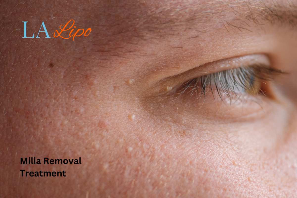 Cryopen Milia Removal: Is It the Easiest and Safest Option Chigwell?