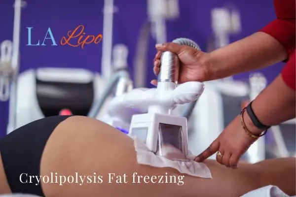 women getting fat freezing Chigwell