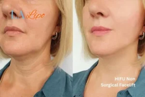 hi-fu for wrinkles Chigwell before and after results