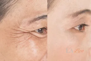 Before and after results of woman - HI-fu wrinkles reduction treatment Chigwell