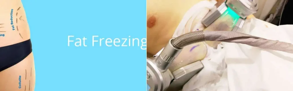 Fat freezing Chigwell on multiple areas of the body
