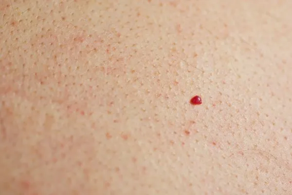 close up of a cherry angioma Chigwell