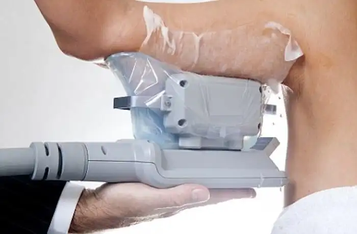 Picture of fat freezing Chigwell on the upper arms.