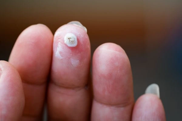 wart on person finger - cryotherapy to treat from LA LIPO Chigwell