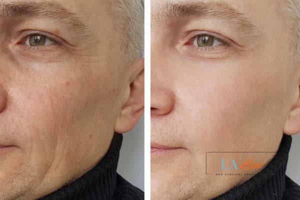 See the amazing results of Morpheus8 Treatment Chigwell!