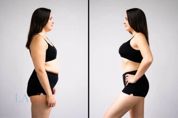 Picture of womans before and after using LA-EMS body sculpting to improve her core strength Chigwell