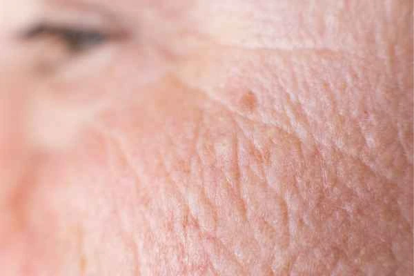 close up picture of a woman's face showing an age spot Chigwell