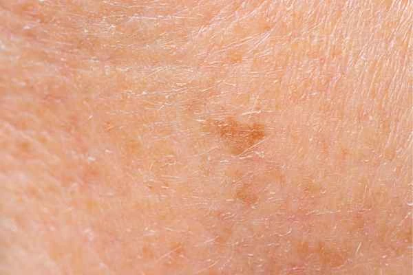 close up picture of age spots Chigwell