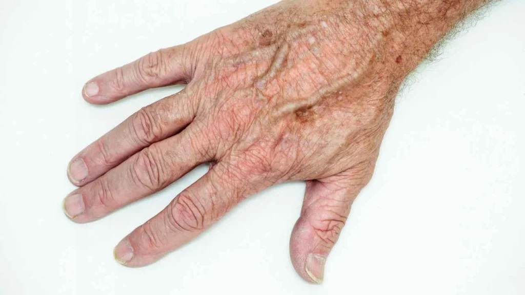 Male hand showing age spot Chigwell