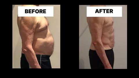 What Symptoms Can Diastasis Recti Cause in Men? Weak Core, Back Pain and Poor Posture Chigwell